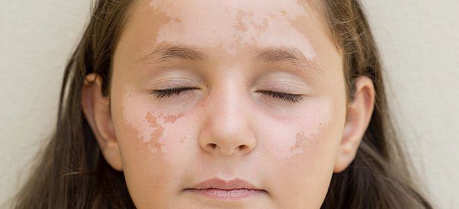 pies pathisis tou dermatos epidinononte apo ton ilio