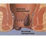 about haemorrhoids