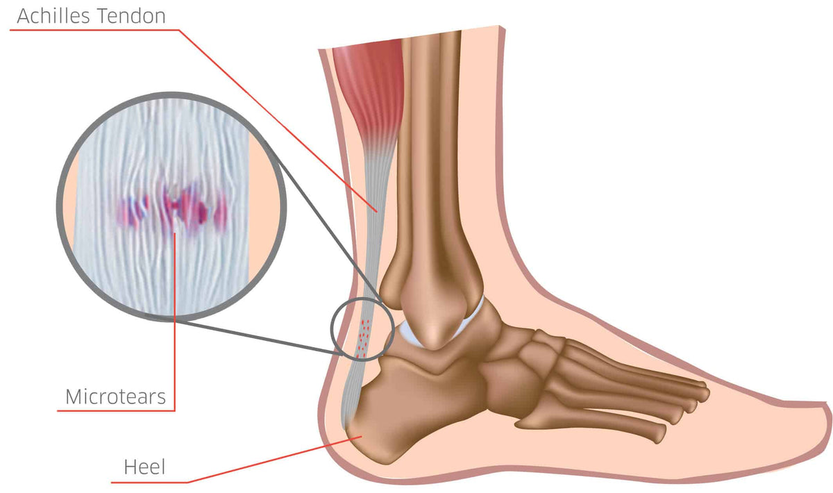 achilles tendonitis