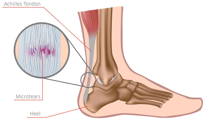 achilles tendonitis